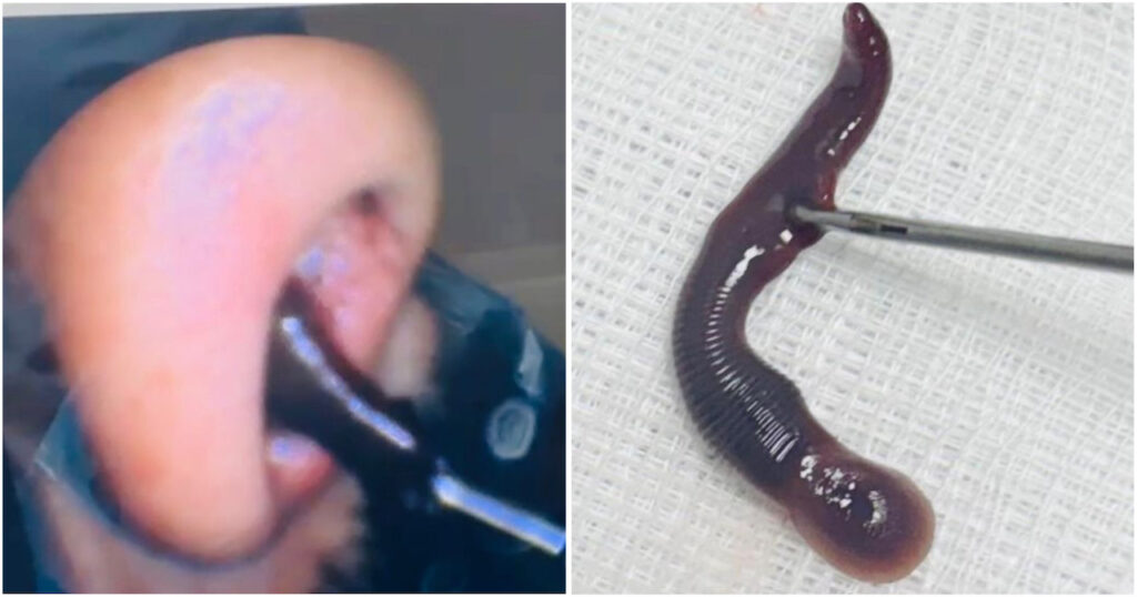 Bloody Surprise: Leech Found Behind Persistent Nosebleeds; Successfully Removed at AIIMS Jammu