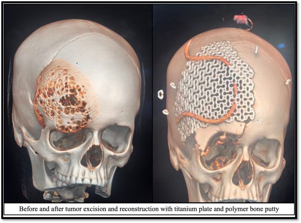 AIIMS Jammu Achieves Milestone with Complex Brain Tumour Surgery on Teenager