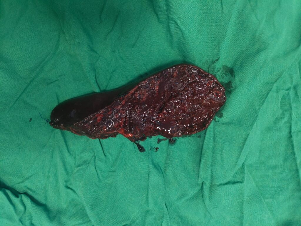 AIIMS Jammu Performs Complex Re-Do Liver Surgery, Marks Major Milestone in Advanced Care