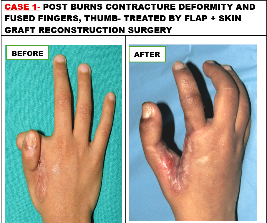 AIIMS Jammu Performs Advanced Reconstructive Surgery on Child With Severe Post-Burn Hand Deformity