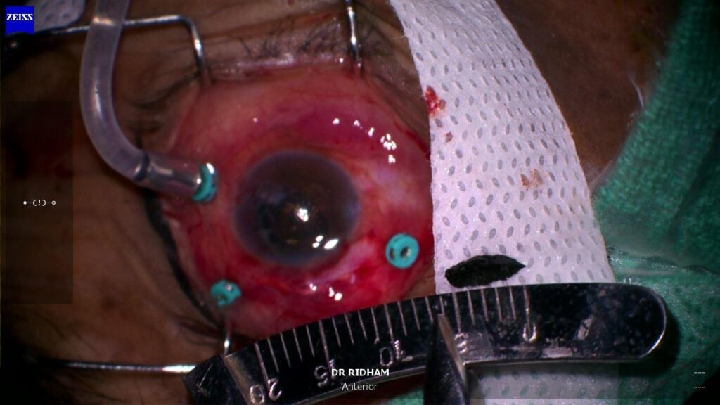 AIIMS Jammu Restores Vision of Patient Injured During Gardening Through Advanced Eye Surgery